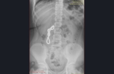 25 магнитиков извлекли из кишечника ребенка хирурги детской больницы № 1